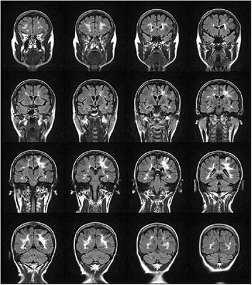 <mark class="highlighted">Multidisciplinary Rehabilitation</mark> is Efficacious and Induces Neural Plasticity in Multiple Sclerosis even when Complicated by Progressive Multifocal Leukoencephalopathy